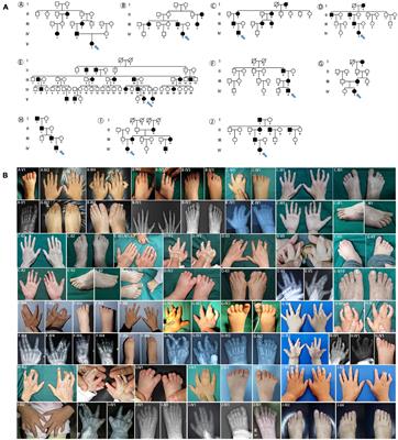 A Novel Missense Variant of HOXD13 Caused Atypical Synpolydactyly by Impairing the Downstream Gene Expression and Literature Review for Genotype–Phenotype Correlations